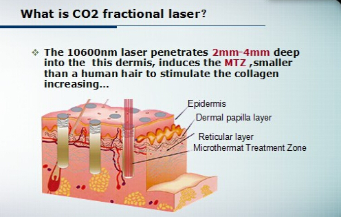 Er700b-Berufsbruch-CO2 Laser für Dehnungsstreifen-Abbau